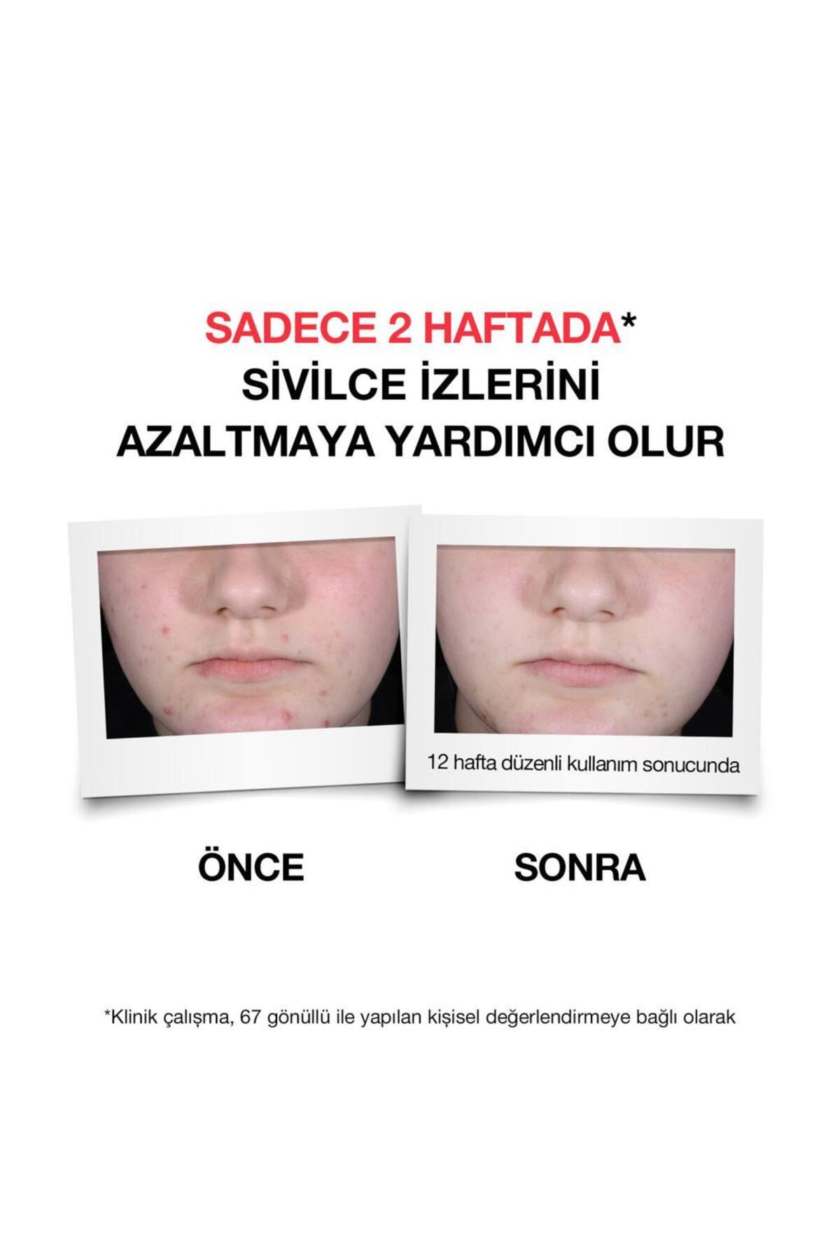 سرم پوست ضد جوش 30 میلی لیتر مناسب برای مراقبت از صورت نوتروژینا Neutrogena
