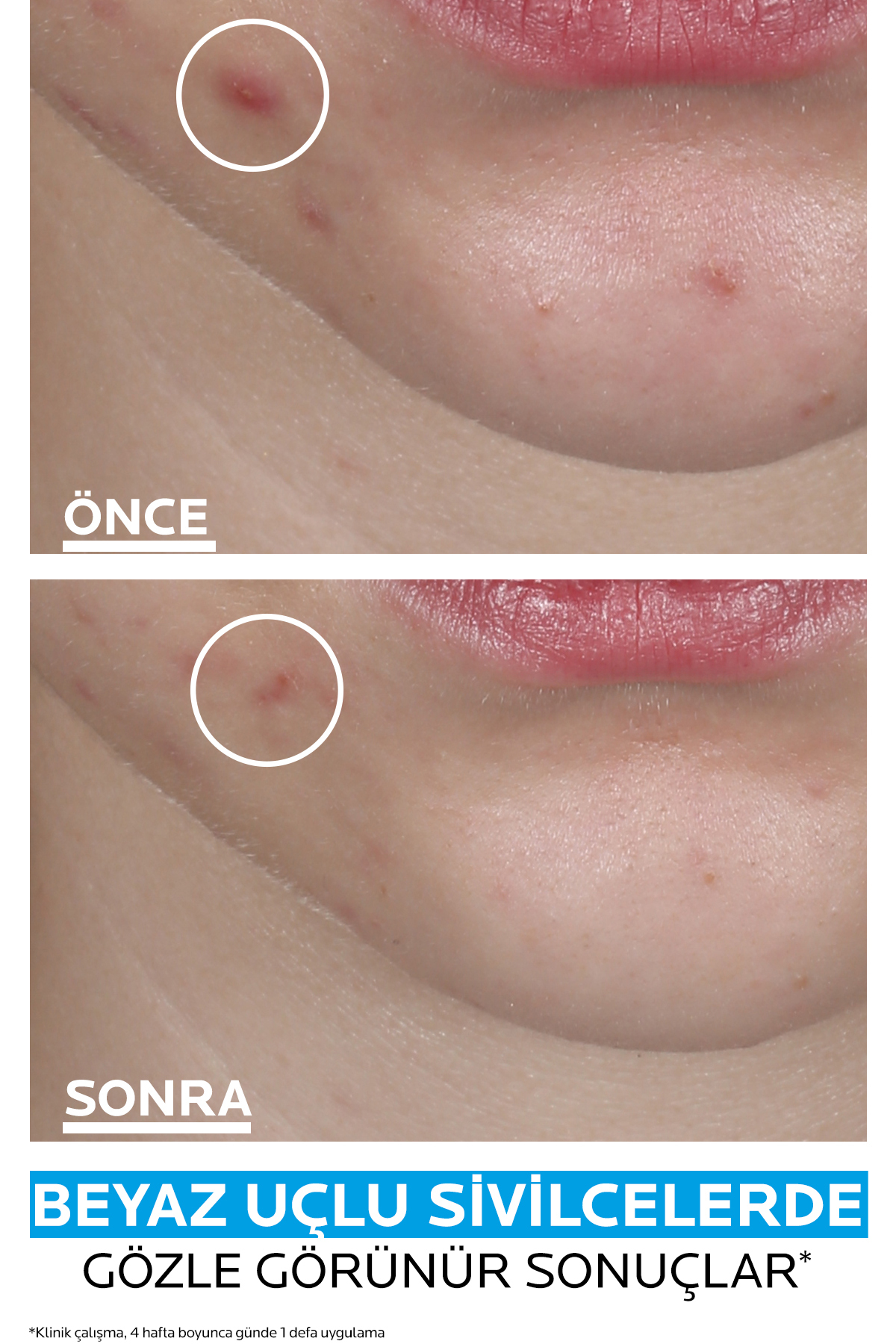 چسب جوش سرسیاه راه حل سریع ANTI ACNE La Roche Posay